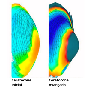topografia do ceratocone