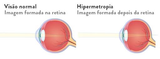Hipermetropia