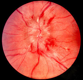 Papilledema