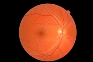 Retina saudável