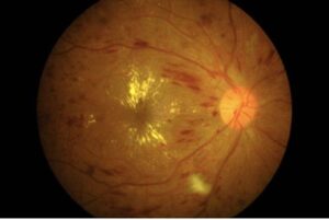 retinoparia diabética